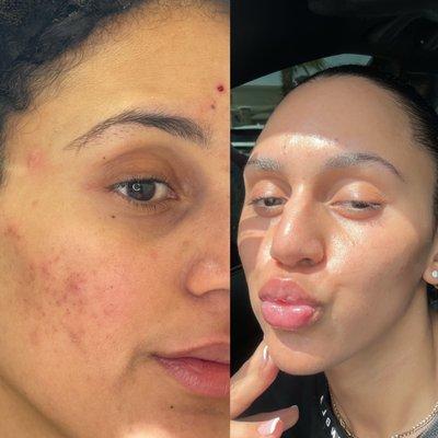 Before and after Perfect Derma Peel and custom skin routine