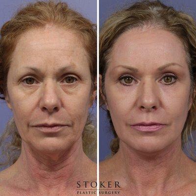 Facelift & neck lift, upper eyelid lift and C02 laser resurfacing by Dr. David Stoker.