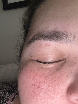 Eyelid cuts from threading