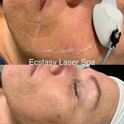 Laser Skin Tightening