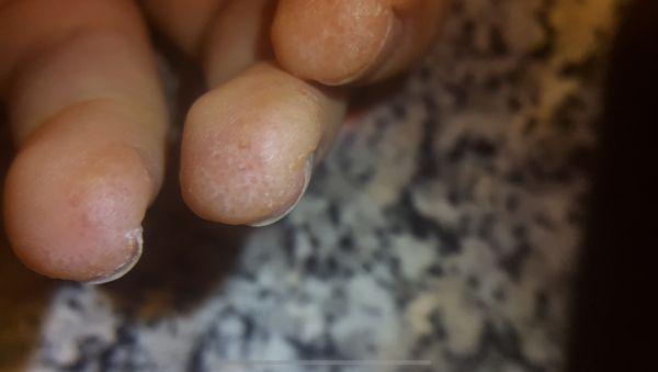 Actual Holes in Finger