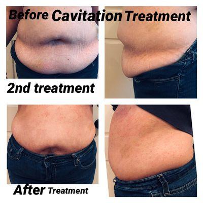 Body Cavitation 2nd treatment before and after