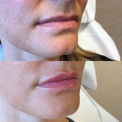 Lip fillers