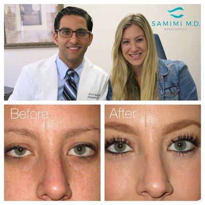 This delightful patient underwent droopy upper eyelid "ptosis" repair surgery on the right upper eyelid to achieve upper eyelid symmetry.