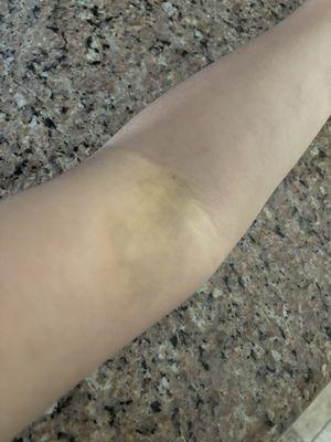 bruised arm