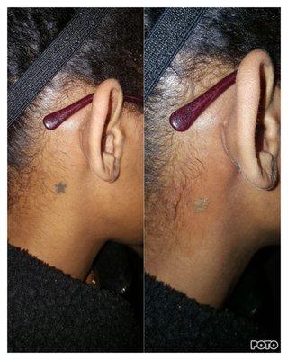 The 1st pic is before, the 2nd is right after treatment.