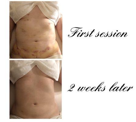 Lymphatic drainage massages post-op before and after 2 weeks.