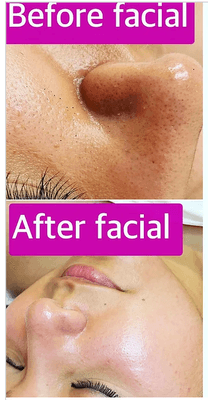 Facial and Hydro Facial