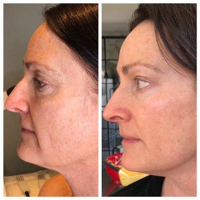 The Ultimate non-surgical facelift!  Treatment #1 (left),Treatment #(10 right).  10 treatments= 10 years off!