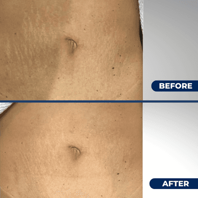 Before & After Fibroblast abdominal stretch marks