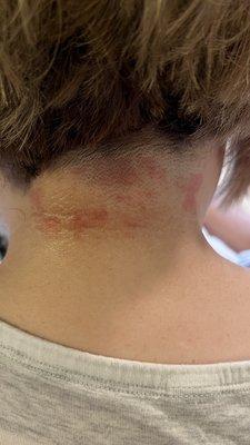 Clipper burns and painful abrasions