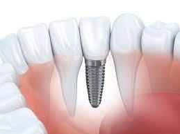 Dental implants