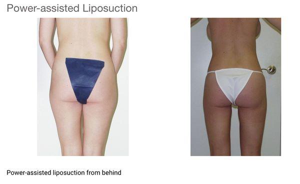 Power Assisted Liposuction