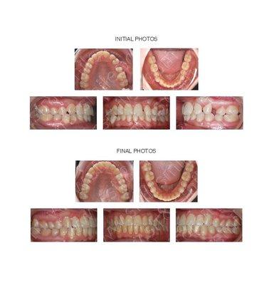 Adult with impacted cuspid tooth treated with surgical exposure and braces.