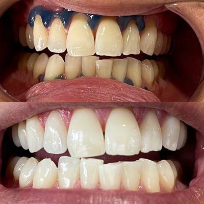 60 Minute Teeth Whitening Session