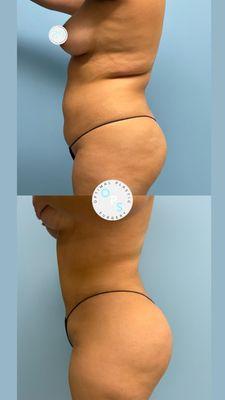 360 Liposuction patient