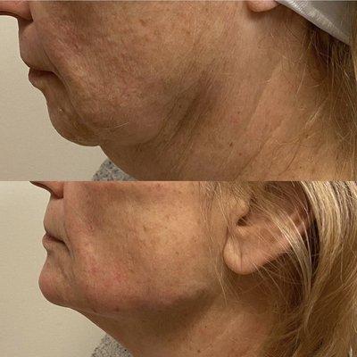 Liquid Facelift and Jawline filler