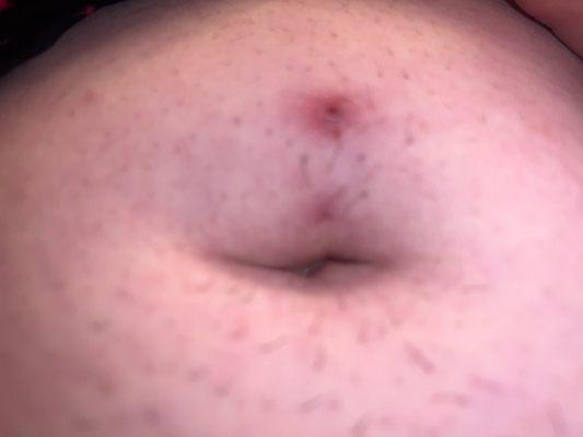 My belly button piercing after being on infection medication for a week it's finally healing