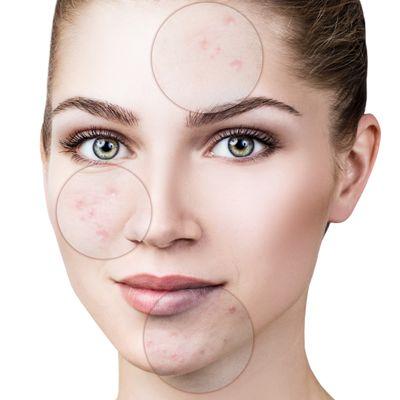 Acne can really affect a person's self esteem and happiness. I specialize in helping you get rid of your acne for good in a private setting.