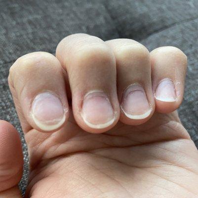 Nail damage from bad manicure.