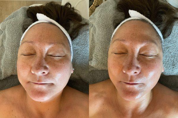 Stunning before & after of client that received our Signature Facial with Hydrodermabrasion & Microcurrent.
 Non-surgical Facelift