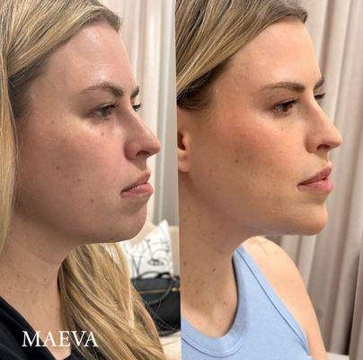 Facial balancing with a focus on natural enhancements. Subtle chin filler brings harmony and definition to this client's profile.