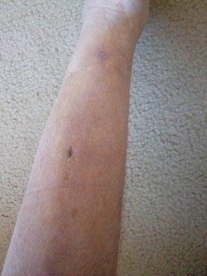 My leg after over two weeks of healing