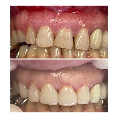 Bioclear bonding to move teeth to midline