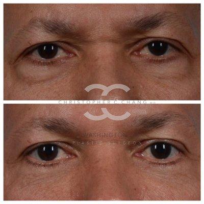 Male lower eyelid bag removal.