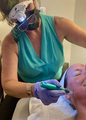 Micro needling with Sara North, LAc