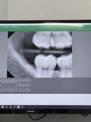 The x ray after my last filling with them that shows it was done incorrectly