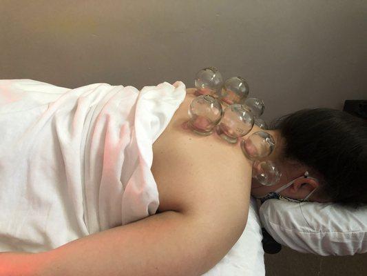 Acupuncture, followed by cupping and manual therapy, can greatly help relieve chronic neck and back pain.