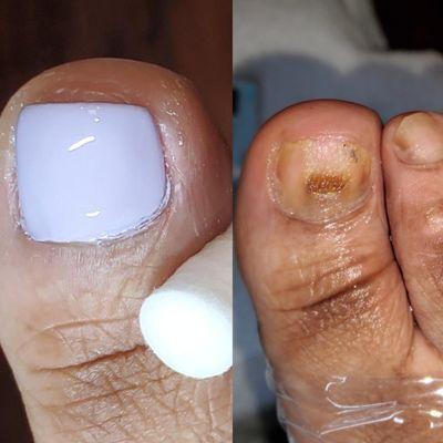 A Gemini Pedicure with a Big Toenail Restoration