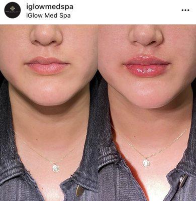 iGlowMedSpa Porter Ranch - Lip Injections Restylane Kysse