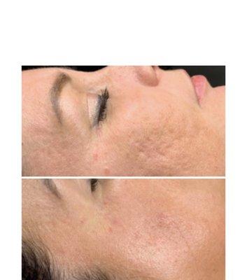 Microneedling is such an amazing treatment look at those results Book now don't wait