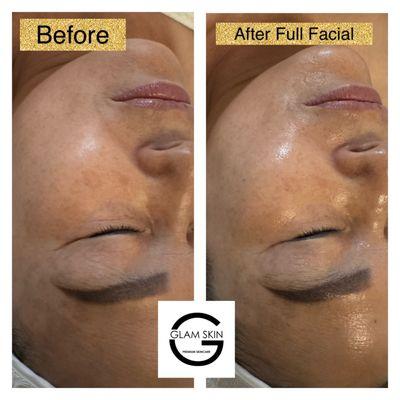 Before and after Full Facial Massage