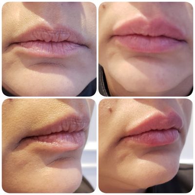 Juvederm for lips