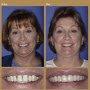 Smile Makeover