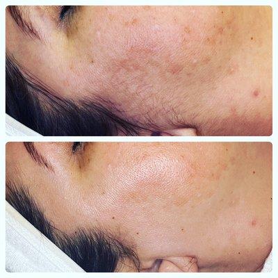 Before and after dermaplane brightening facial