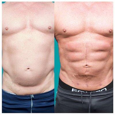 High Definition Abdominal Etching Liposuction Done in Office Under Local Numbing