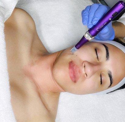 NANO NEEDLING Treatments