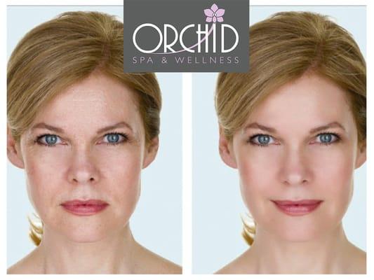 CooLifting offers two main benefits. First, it lifts. The lift eliminates superficial wrinkles. Deep wrinkles  reduce. The lift also lighten