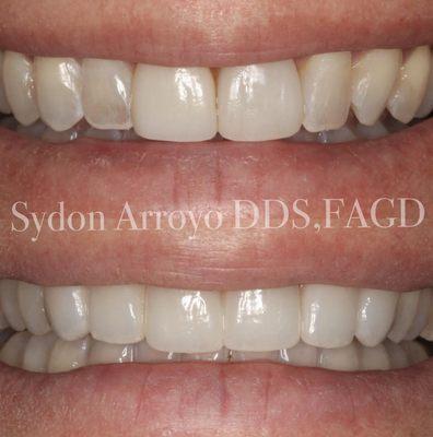 Layered Porcelain Veneers