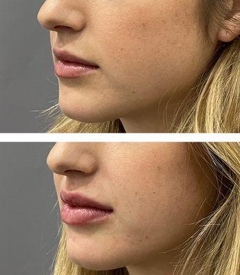 0.5 syringe lip filler