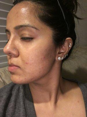 This is the result of acne treatments and a peel series. Her skin improved drastically in 2-3 treatments.