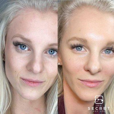 Facial Slimming