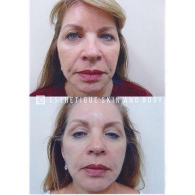 Before and after of skin tightening treatment