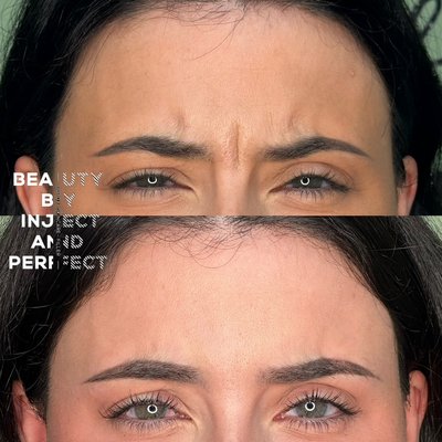 Beautify  Botox treatment