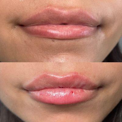 Say hello to plump, luscious lips with Restylane Kysse!