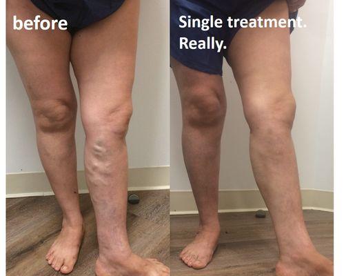 Dr. Malvehy offers varicose vein removal in a single treatment.